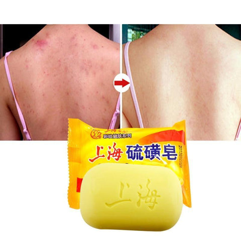 Image of Acne Treatment Control Soap