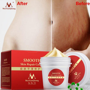 Scar Removal Cream Stretch Marks Repair Skin