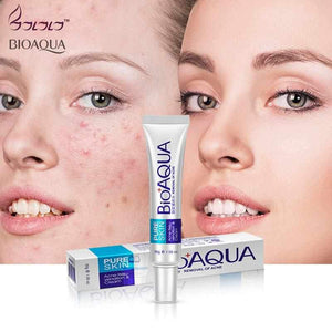 New Anti Acne Treatment - Cream Oil Control